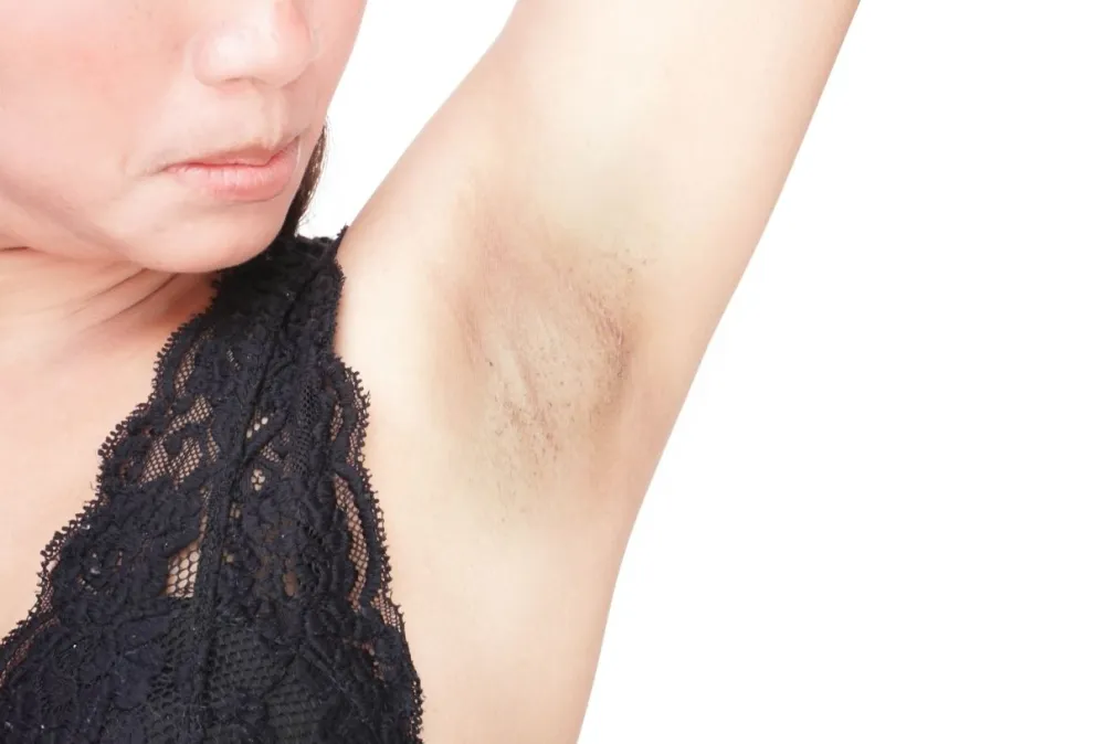 Dile adiós a las manchas de las axilas con este remedio casero