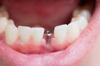 ANMAT prohibió el uso, venta y distribución de una marca de implantes dentales