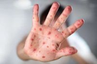 Se confirmó el primer caso de sarampión en Salta: se trata de un niño de 19 meses