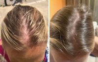 Alopecia: conocé los 3 fabulosos tónicos naturales para evitar la caída del cabello