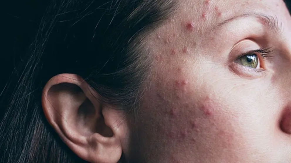 Descubrí el ingrediente secreto para tratar el acné: una terapia casera que dejará tu piel luminosa y sin manchas