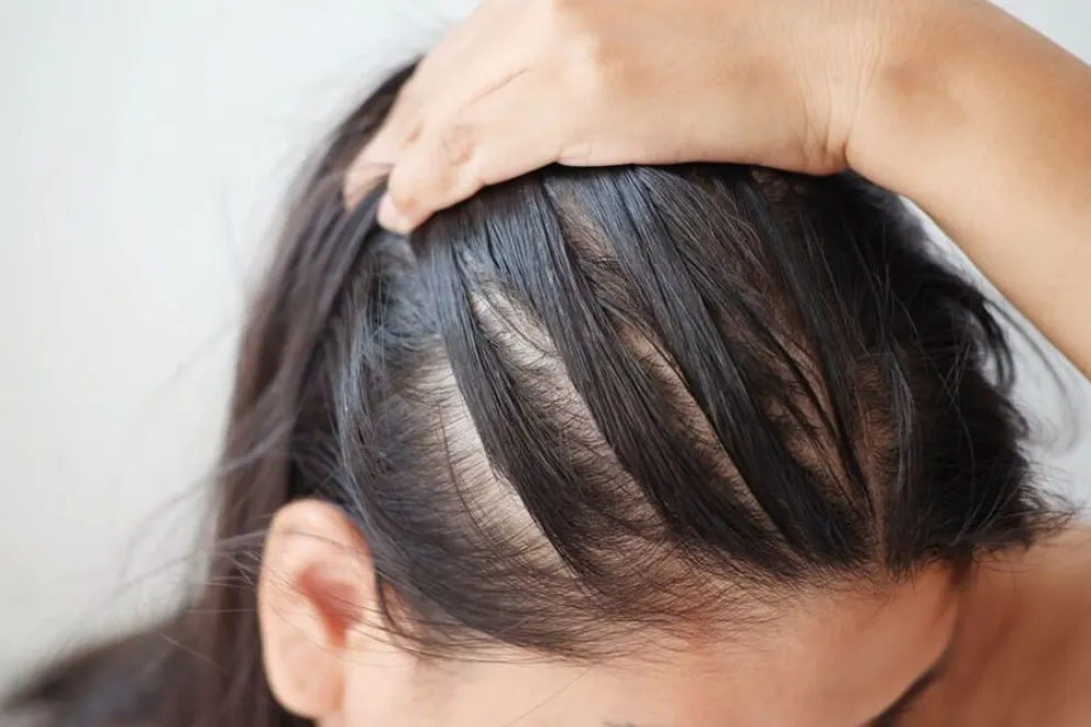 menopausia-p&eacute;rdida de cabello
