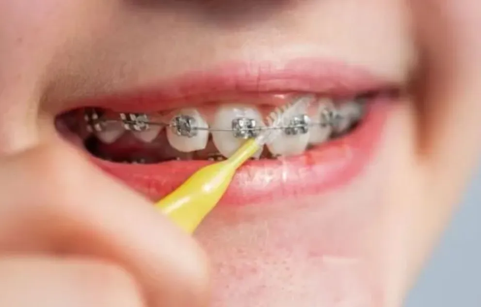ANMAT prohibió el uso y colocación de brackets: cuál marca es nociva para la salud