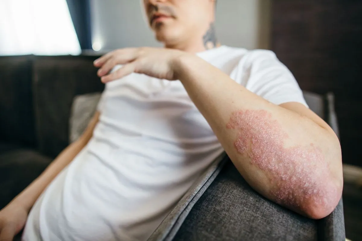 Psoriasis en Salta
