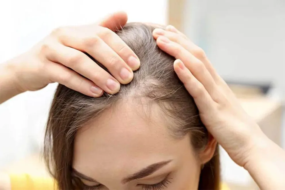 alopecia 
