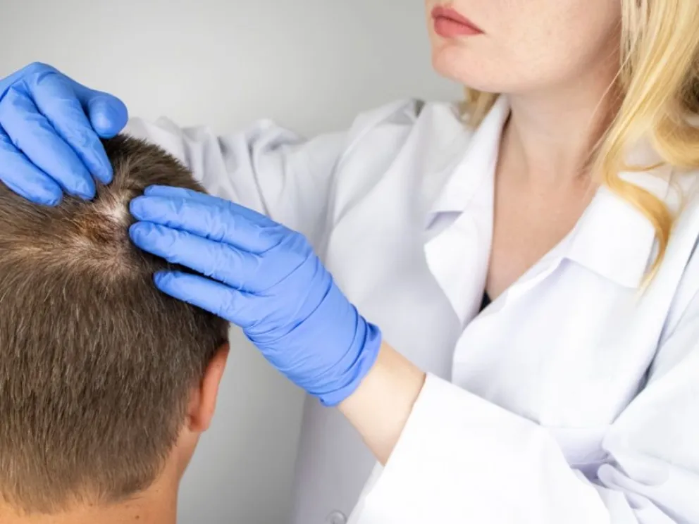alopecia 