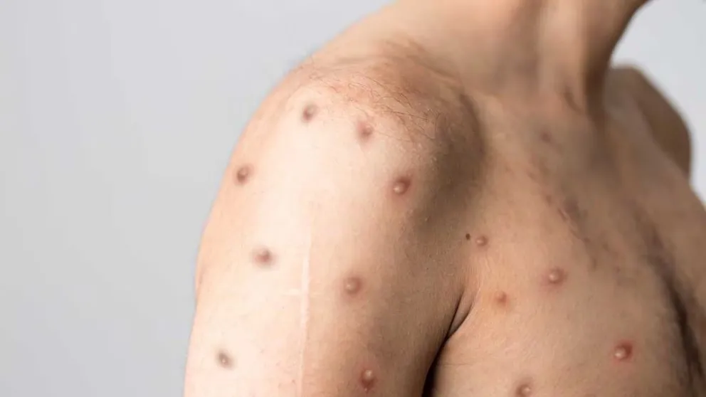 Viruela del mono: el Gobierno Nacional dictaminó quiénes tienen que vacunarse contra el virus mpox
