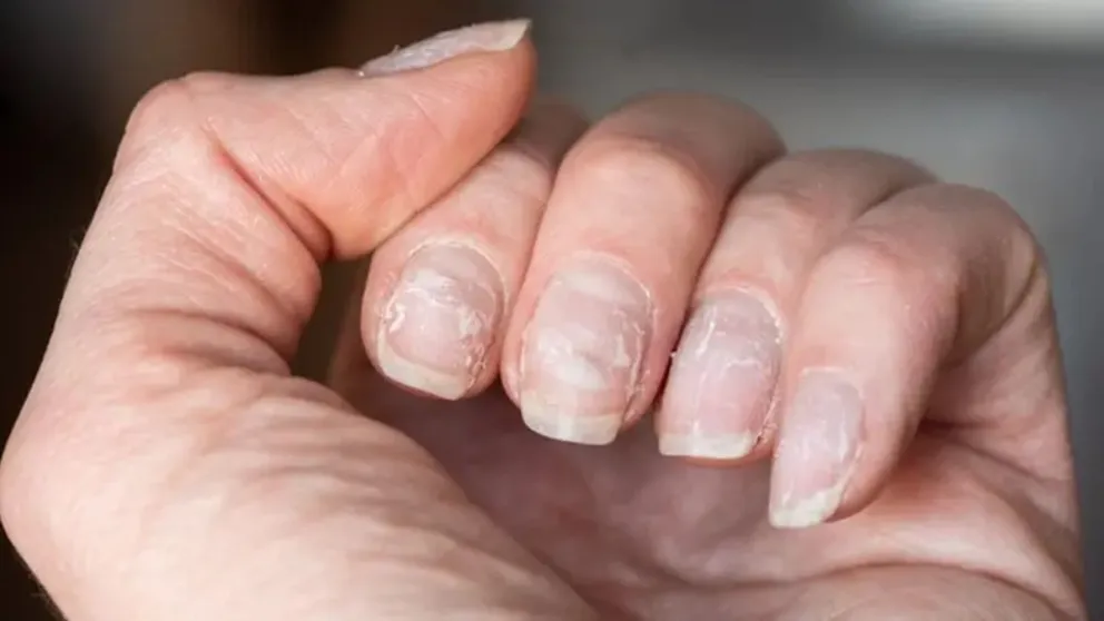 Conocé las principales causas de las uñas escamadas y las recomendaciones para tratarlas y prevenirlas