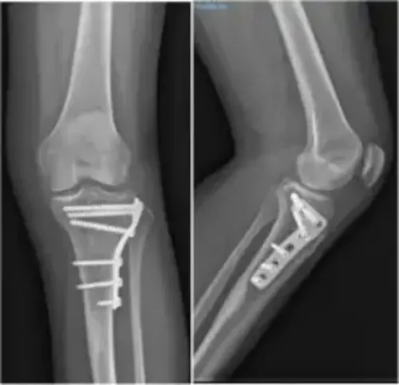 fractura