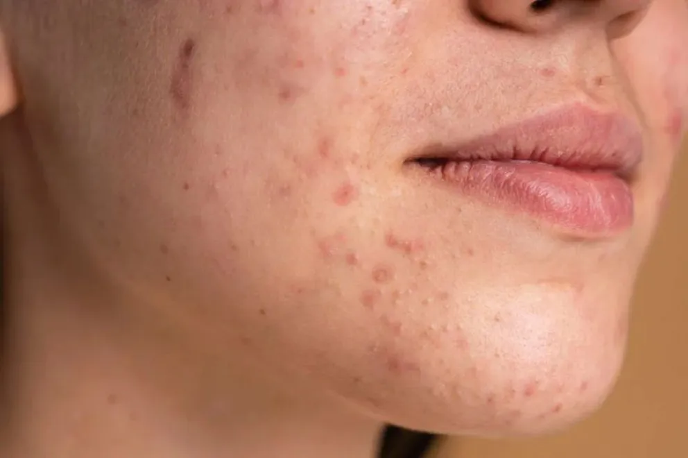 Mascarilla para puntos negros y piel grasa